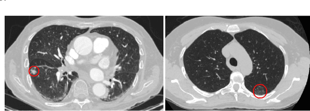 Figure 4 for MIXCAPS: A Capsule Network-based Mixture of Experts for Lung Nodule Malignancy Prediction