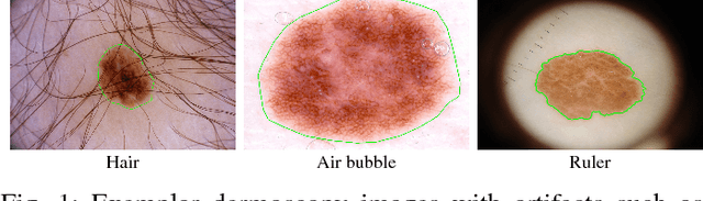Figure 1 for Unsupervised and semi-supervised learning with Categorical Generative Adversarial Networks assisted by Wasserstein distance for dermoscopy image Classification