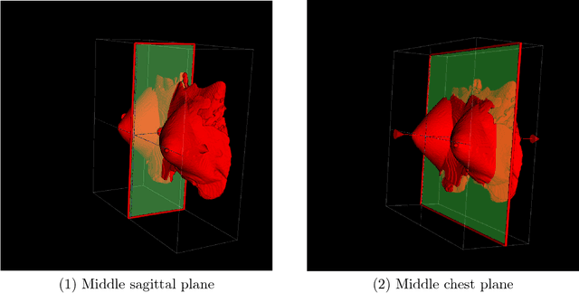 Figure 3 for Automated detection and segmentation of non-mass enhancing breast tumors with dynamic contrast-enhanced magnetic resonance imaging