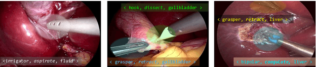 Figure 1 for CholecTriplet2021: A benchmark challenge for surgical action triplet recognition