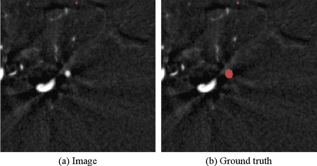 Figure 1 for Exploring Large Context for Cerebral Aneurysm Segmentation