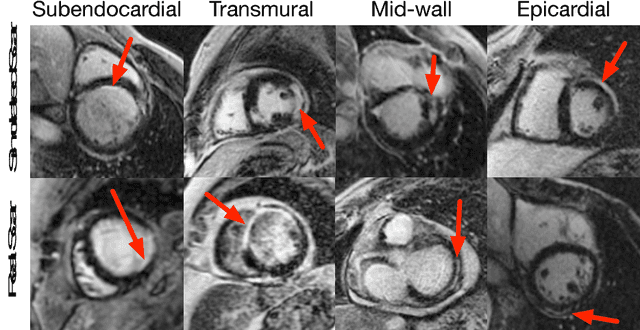 Figure 1 for ScarGAN: Chained Generative Adversarial Networks to Simulate Pathological Tissue on Cardiovascular MR Scans