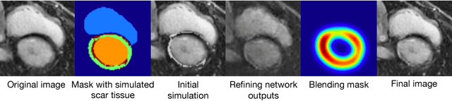 Figure 4 for ScarGAN: Chained Generative Adversarial Networks to Simulate Pathological Tissue on Cardiovascular MR Scans