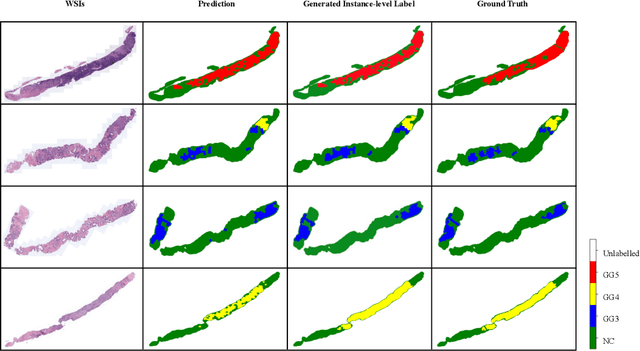 Figure 4 for Multiple Instance Learning with Mixed Supervision in Gleason Grading