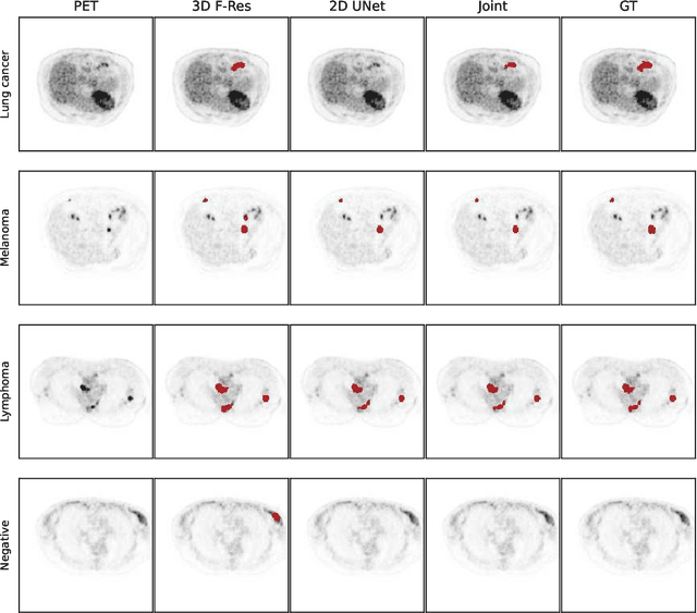 Figure 4 for Whole-Body Lesion Segmentation in 18F-FDG PET/CT