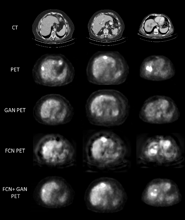 Figure 4 for Virtual PET Images from CT Data Using Deep Convolutional Networks: Initial Results