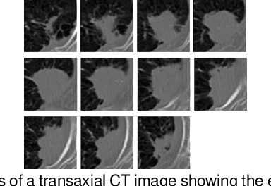 Figure 1 for Attention-Enhanced Cross-Task Network for Analysing Multiple Attributes of Lung Nodules in CT
