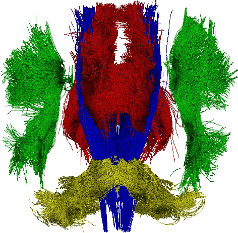 Figure 2 for The varifold representation of non-oriented shapes for diffeomorphic registration
