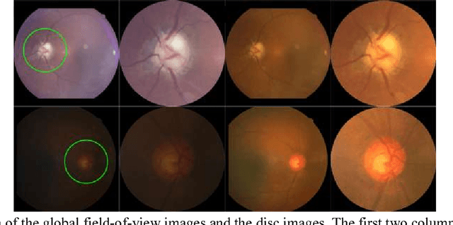 Figure 3 for Performance assessment of the deep learning technologies in grading glaucoma severity