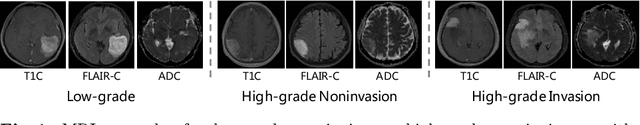 Figure 1 for Joint Prediction of Meningioma Grade and Brain Invasion via Task-Aware Contrastive Learning