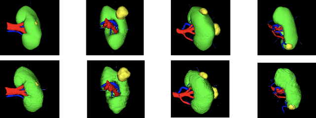 Figure 4 for Multi-structure segmentation for renal cancer treatment with modified nn-UNet