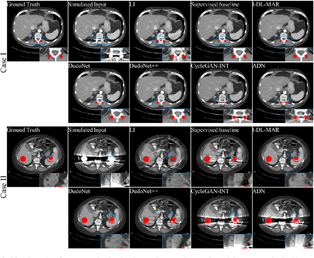 Figure 3 for Investigation of domain gap problem in several deep-learning-based CT metal artefact reduction methods