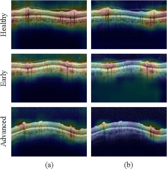 Figure 4 for A self-training framework for glaucoma grading in OCT B-scans