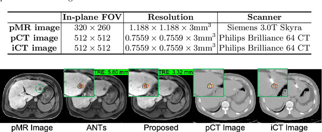 Figure 2 for Synthesis and Inpainting-Based MR-CT Registration for Image-Guided Thermal Ablation of Liver Tumors