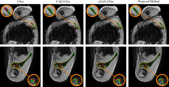 Figure 4 for Combining Shape Priors with Conditional Adversarial Networks for Improved Scapula Segmentation in MR images