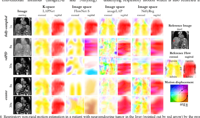Figure 4 for LAPNet: Non-rigid Registration derived in k-space for Magnetic Resonance Imaging