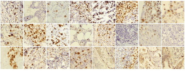 Figure 1 for PathoNet: Deep learning assisted evaluation of Ki-67 and tumor infiltrating lymphocytes (TILs) as prognostic factors in breast cancer; A large dataset and baseline