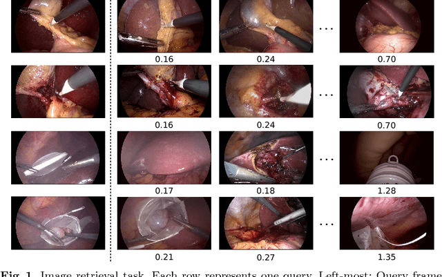 Figure 2 for Temporal coherence-based self-supervised learning for laparoscopic workflow analysis