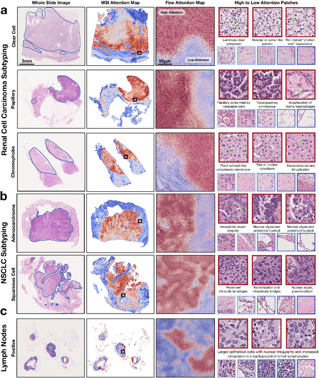 Figure 4 for Data Efficient and Weakly Supervised Computational Pathology on Whole Slide Images