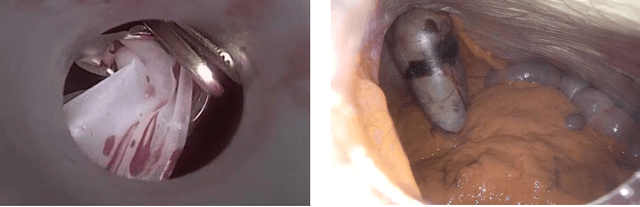 Figure 3 for Federated Cycling (FedCy): Semi-supervised Federated Learning of Surgical Phases