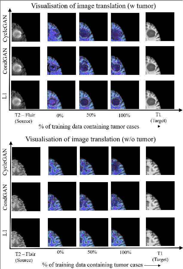 Figure 3 for Visualisation of Medical Image Fusion and Translation for Accurate Diagnosis of High Grade Gliomas