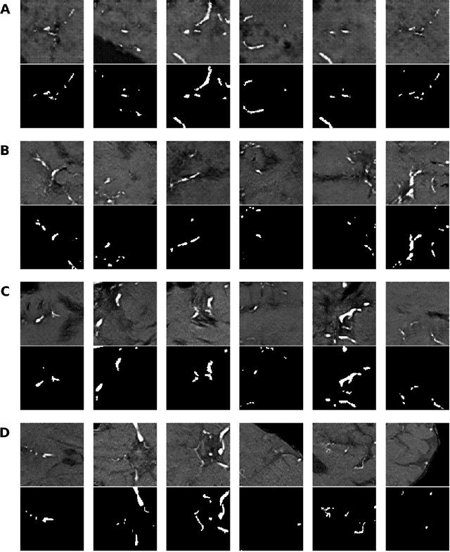 Figure 3 for Anonymization of labeled TOF-MRA images for brain vessel segmentation using generative adversarial networks