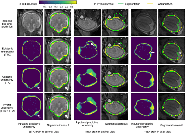 Figure 1 for Aleatoric uncertainty estimation with test-time augmentation for medical image segmentation with convolutional neural networks
