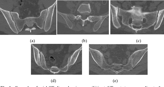 Figure 1 for Automatic detection and diagnosis of sacroiliitis in CT scans as incidental findings