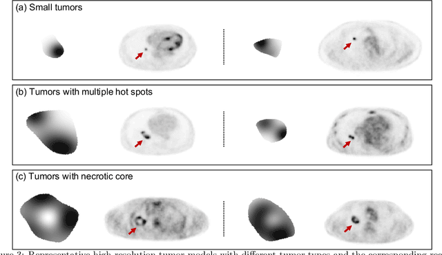 Figure 4 for Observer study-based evaluation of a stochastic and physics-based method to generate oncological PET images