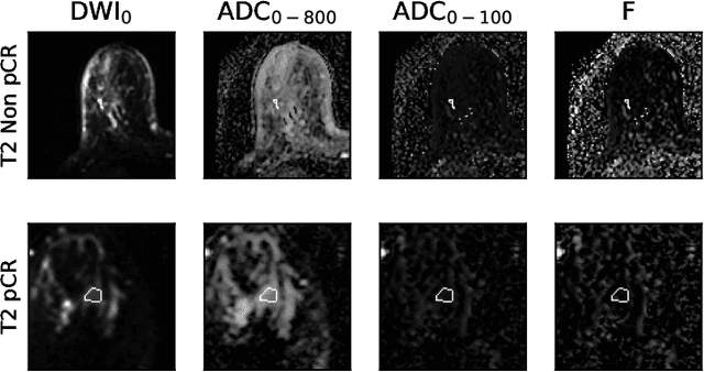 Figure 3 for PD-DWI: Predicting response to neoadjuvant chemotherapy in invasive breast cancer with Physiologically-Decomposed Diffusion-Weighted MRI machine-learning model