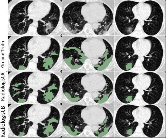 Figure 1 for GASNet: Weakly-supervised Framework for COVID-19 Lesion Segmentation