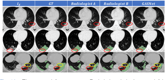 Figure 2 for GASNet: Weakly-supervised Framework for COVID-19 Lesion Segmentation
