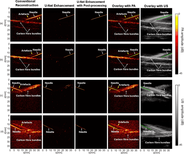 Figure 4 for Improving needle visibility in LED-based photoacoustic imaging using deep learning with semi-synthetic datasets