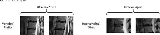 Figure 2 for Self-Supervised Learning for Spinal MRIs
