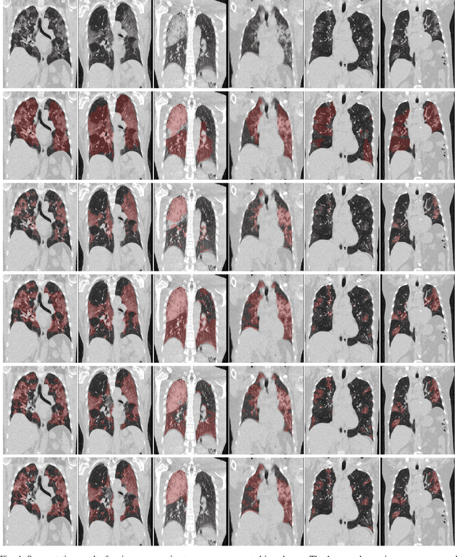 Figure 4 for Dense Regression Activation Maps For Lesion Segmentation in CT scans of COVID-19 patients