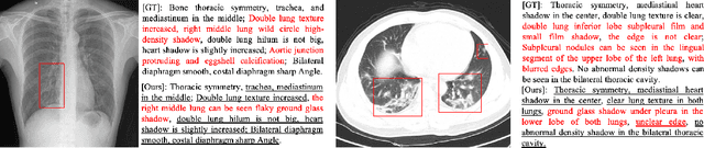 Figure 1 for Auxiliary Signal-Guided Knowledge Encoder-Decoder for Medical Report Generation