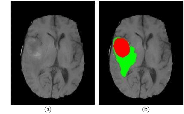 Figure 1 for Glioma Grade Predictions using Scattering Wavelet Transform-Based Radiomics
