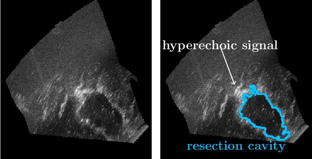 Figure 1 for RESECT-SEG: Open access annotations of intra-operative brain tumor ultrasound images