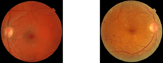 Figure 4 for Deep Semi-Supervised and Self-Supervised Learning for Diabetic Retinopathy Detection