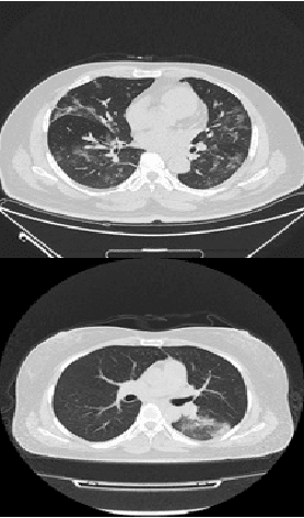 Figure 2 for A Transfer Learning Based Approach for Classification of COVID-19 and Pneumonia in CT Scan Imaging