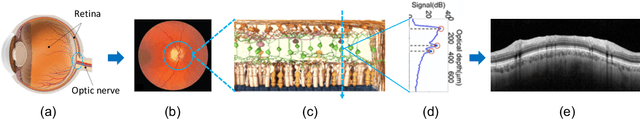 Figure 1 for Circumpapillary OCT-Focused Hybrid Learning for Glaucoma Grading Using Tailored Prototypical Neural Networks
