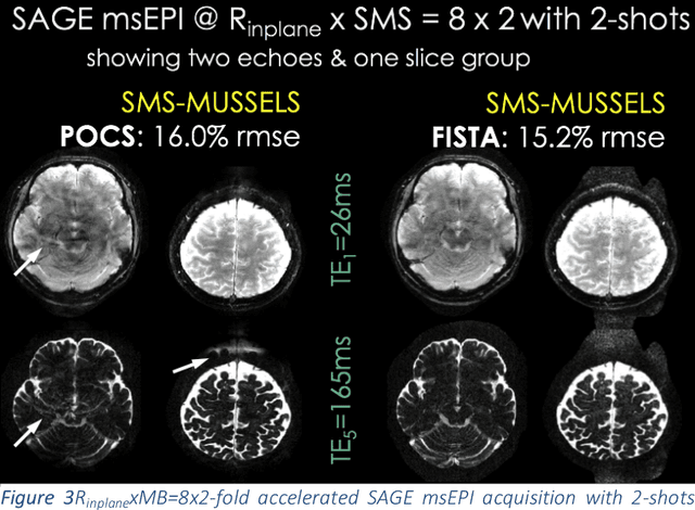 Figure 3 for Highly Accelerated Multishot EPI through Synergistic Combination of Machine Learning and Joint Reconstruction