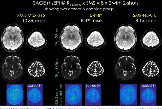 Figure 4 for Highly Accelerated Multishot EPI through Synergistic Combination of Machine Learning and Joint Reconstruction