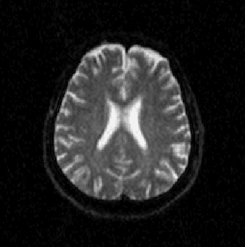 Figure 1 for Evaluation of Alzheimer's Disease by Analysis of MR Images using Multilayer Perceptrons and Kohonen SOM Classifiers as an Alternative to the ADC Maps