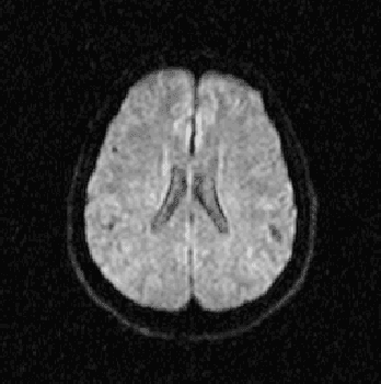 Figure 2 for Evaluation of Alzheimer's Disease by Analysis of MR Images using Multilayer Perceptrons and Kohonen SOM Classifiers as an Alternative to the ADC Maps