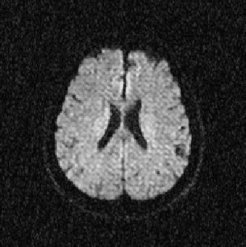 Figure 3 for Evaluation of Alzheimer's Disease by Analysis of MR Images using Multilayer Perceptrons and Kohonen SOM Classifiers as an Alternative to the ADC Maps