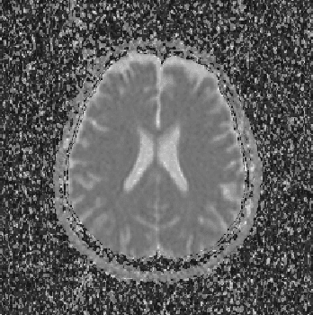 Figure 4 for Evaluation of Alzheimer's Disease by Analysis of MR Images using Multilayer Perceptrons and Kohonen SOM Classifiers as an Alternative to the ADC Maps