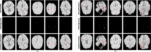 Figure 2 for Adversarial cycle-consistent synthesis of cerebral microbleeds for data augmentation