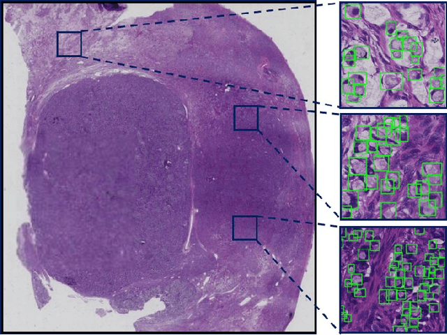 Figure 4 for Signet Ring Cell Detection With a Semi-supervised Learning Framework