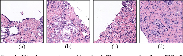 Figure 4 for Self-learning for weakly supervised Gleason grading of local patterns